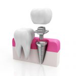 Los dientes implantes dentales de alta tecnología