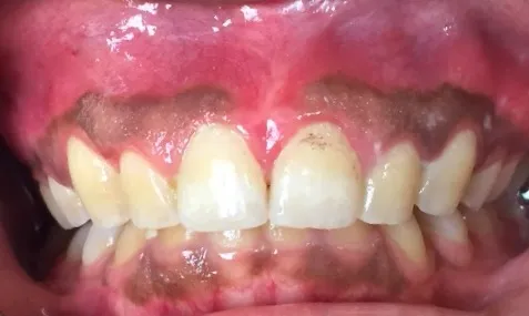 la boca del paciente después de alargamiento de la corona