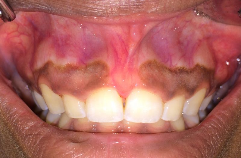 la boca del paciente antes de alargamiento de la corona