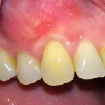 la boca del paciente después del injerto de las encías