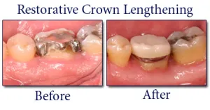 Restorative crown lengthening, before & after