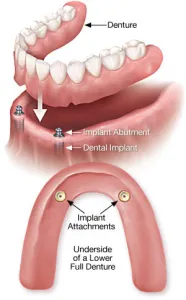 Diagram of implant-supported overdentures attaching to dental implants