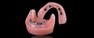 Implant-supported overdentures and a locator bar