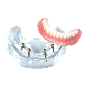 Model of implant-supported overdentures