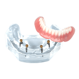 Model of implant-supported overdentures