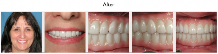 Fotos de la cara y la boca de un paciente después de TeethXpress® implantes dentales