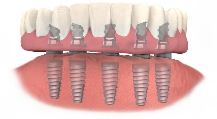 Diagrama de implantes dentales TeethXpress