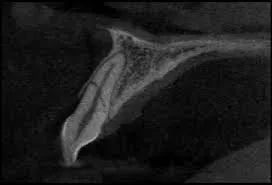 Tooth fracture x-ray