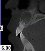 Teeth misalignment x-ray