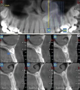 Impacted tooth x-ray