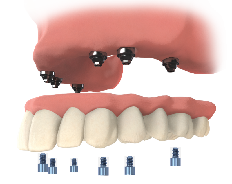 implantes dentales unidad Max Multi