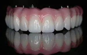 implantes dentales TeethXpress