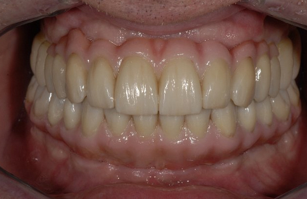 implantes dentales TeethXpress en la boca de una persona