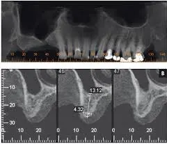 Jaw ridge x-ray