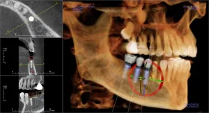 Dental Implant x-ray