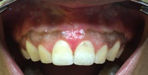 Patient's mouth before gingival depigmentation