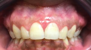 Patient's mouth after gingival depigmentation